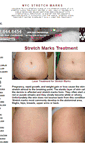 Mobile Screenshot of nycstretchmarks.org